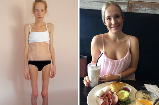 Анорексички: фото до и после, вес девушек